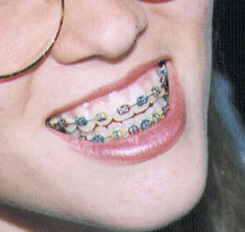 braces removing remove photoshop